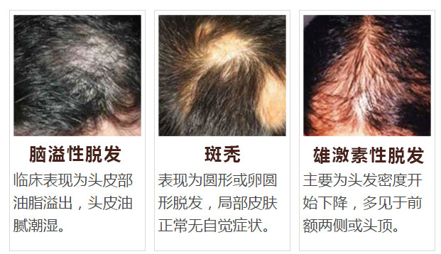 脱发有6种类型（图片）