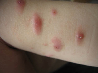 有丘疹性荨麻疹有什么症状
